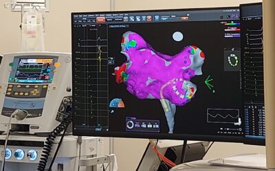 Al Papardo nuova tecnica per la fibrillazione atriale: Ablazione cardiaca con elettroporazione